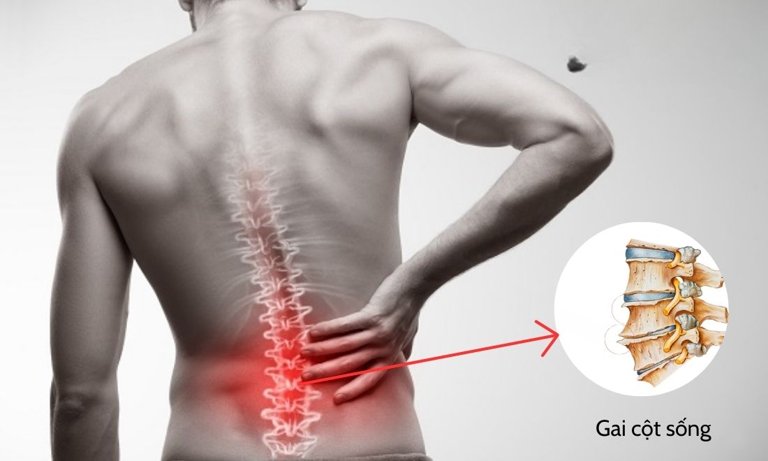 Gai cột sống cũng là lý do gây ra tình trạng ngồi lâu bị đau lưng trên hay dưới, trái, phải